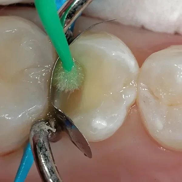 Septodont Secure 5th Generation Bond - Image 3