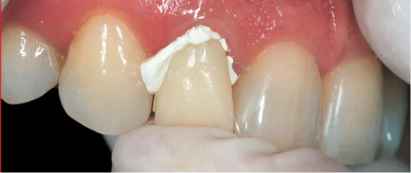 GC Freegenol 1-1 Pkg - Image 2