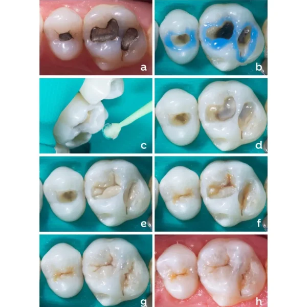 Septodont Endure Nano Hybrid Composite Kit - Image 2