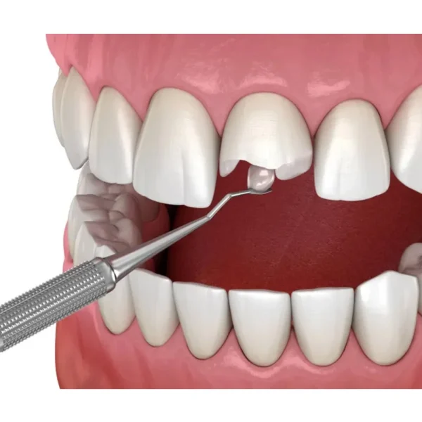Septodont Endure Nano Hybrid Composite Kit - Image 3