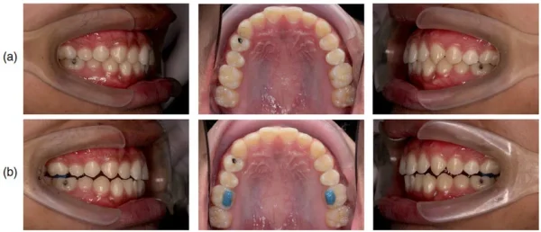 Anabond Blu Bite - Image 3