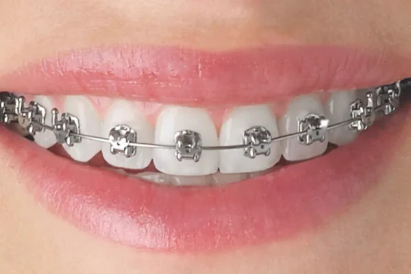 Arch Wire - Image 4