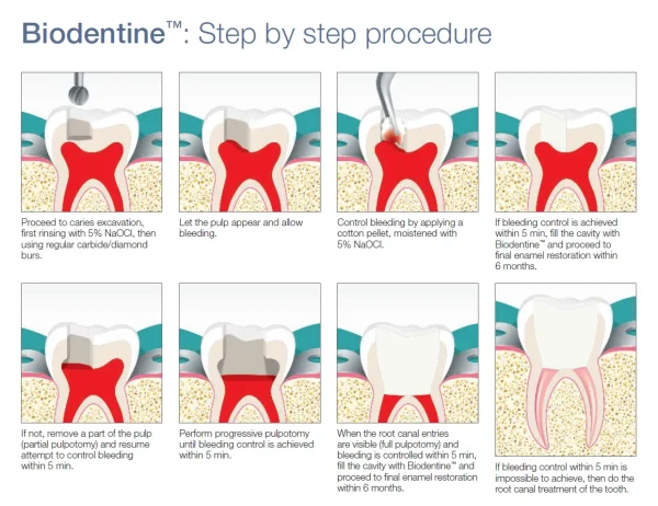 Septodont Biodentine Kit ( Pack of 5 capsules ) - Image 6