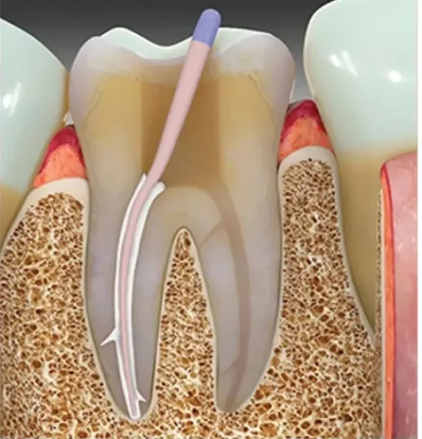 Dentsply Ah Plus Root Canal Sealant - Image 2
