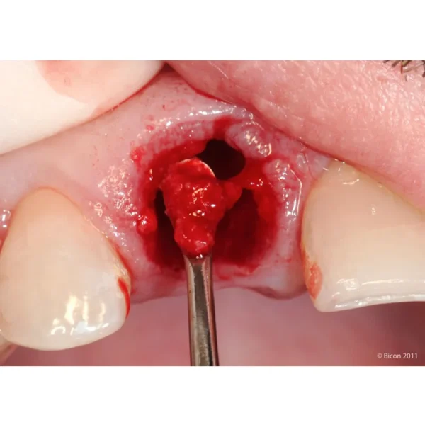 Surgical Curette GDC - Image 2