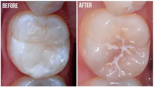 Protec Pit & Fissure Sealant - Image 3