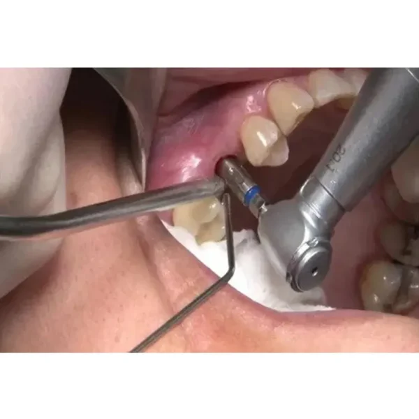 Suction Tip Metallic - Image 2