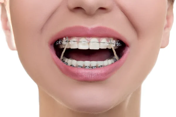 Intra Oral Elastic 5/16" - Image 2